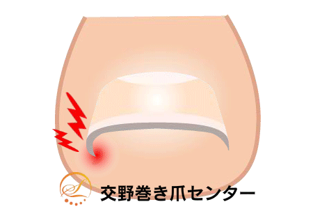 巻き爪矯正の図解